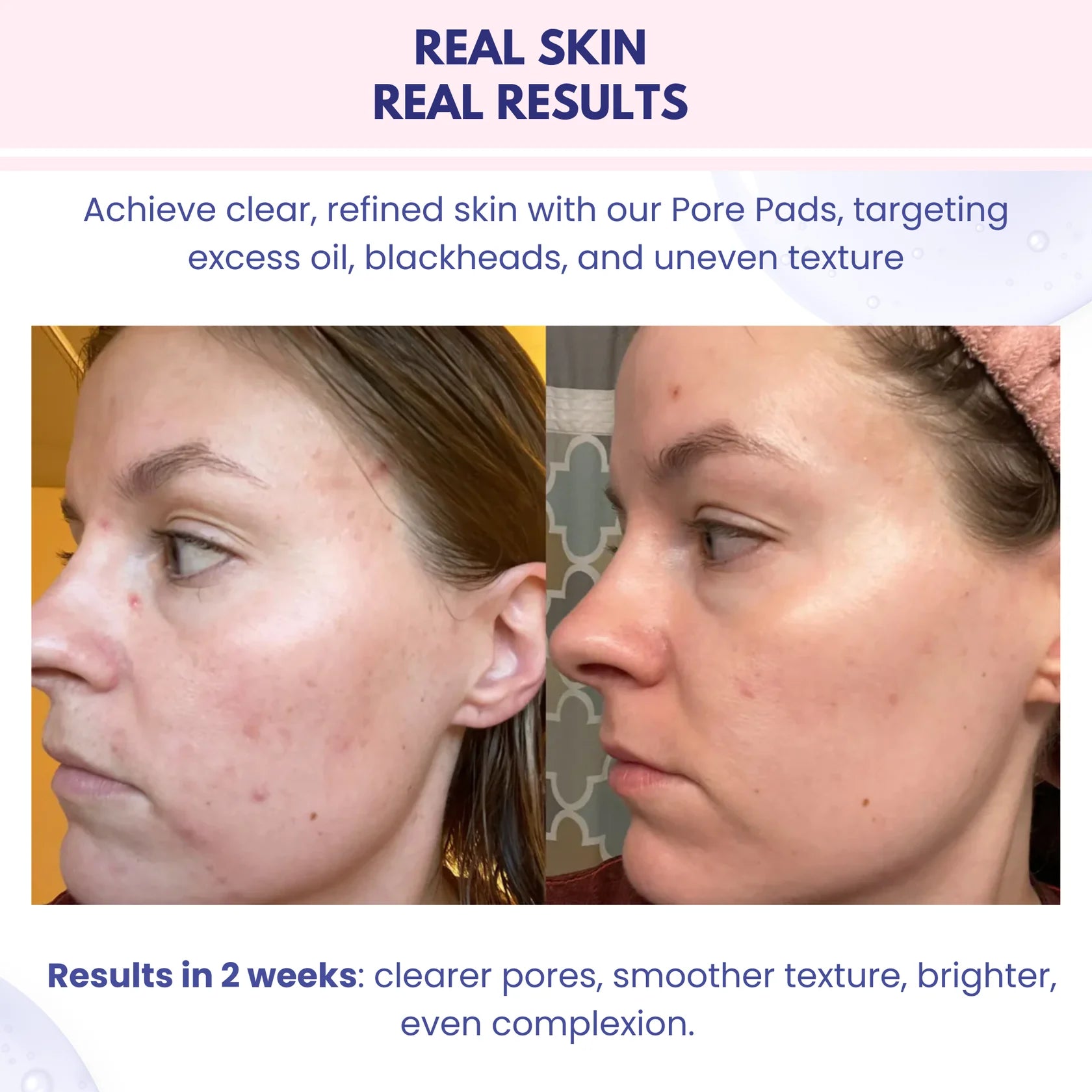 NARAE Pure Glow Pore Pad (70 Pore Pads) RESULTS