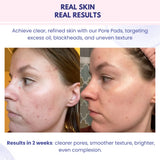 NARAE Pure Glow Pore Pad (70 Pore Pads) RESULTS