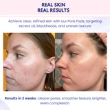 NARAE Pure Glow Pore Pad (70 Pore Pads) RESULTS