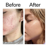The Inkey List Beta Hydroxy Acid Serum 30ml