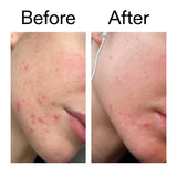 The Inkey List Blemish Clearing Moisturizer 50ml