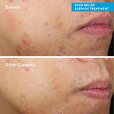 Murad Blemish Control Deep Relief Blemish Treatment 30ml