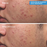 Murad Blemish Control Rapid Relief Spot Treatment 15ml